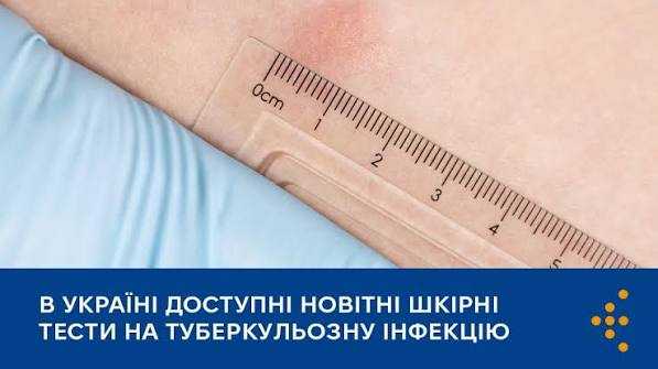 В УКРАЇНІ ДОСТУПНІ НОВІТНІ ШКІРНІ ТЕСТИ НА ТУБЕРКУЛЬОЗНУ ІНФЕКЦІЮ